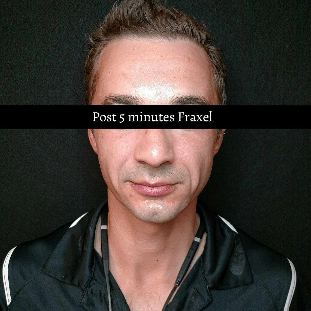 Turn Back Time With Fraxel