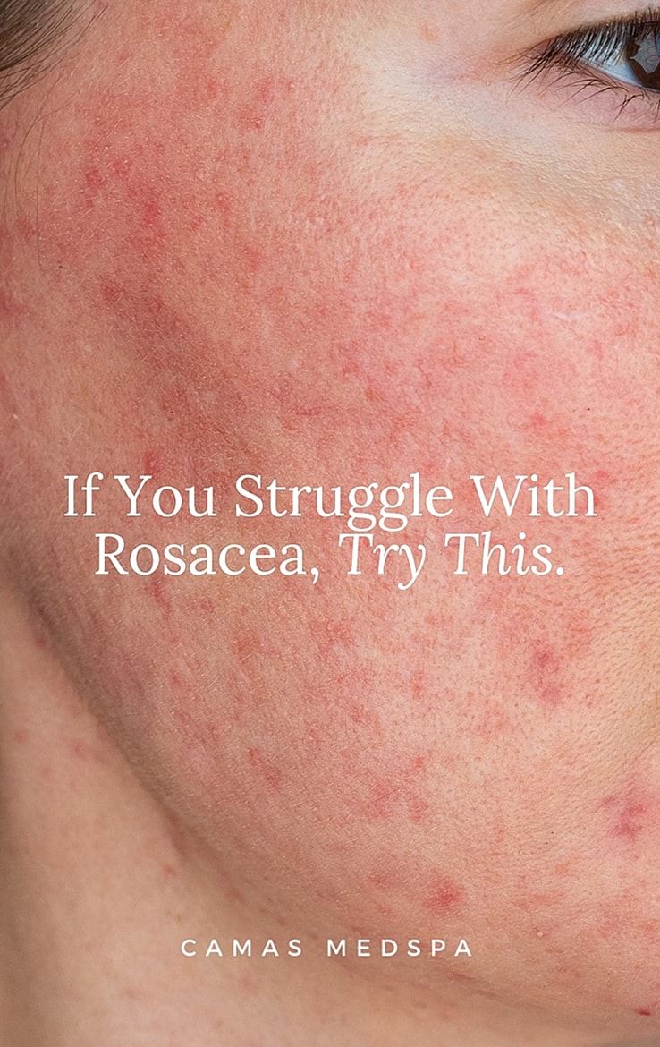 Skin with rosacea and a treatment suggestion.